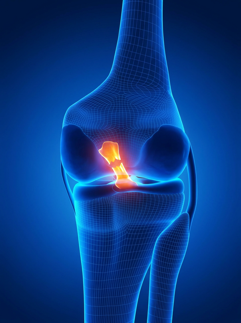 ACL Tear