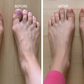 OrthoSoft™ Bunion Corrector